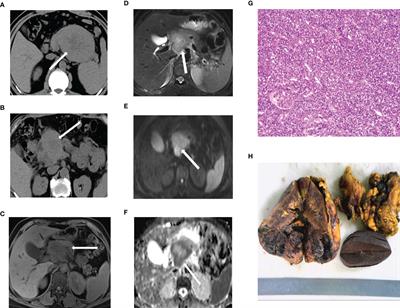 Imaging and Clinicopathological Features of Acinar Cell Carcinoma